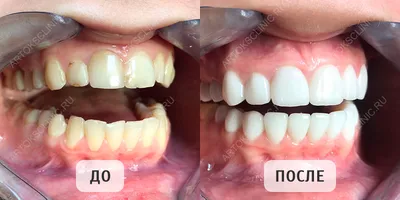 Виниры — вкладки на передние зубы - Стоматологический центр \"Винир\"