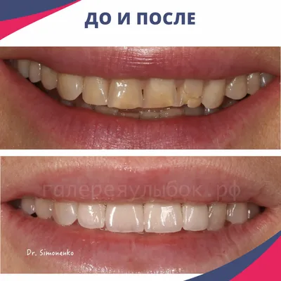 Установка виниров цена на один зуб в Москве для устранения эстетических  дефектов