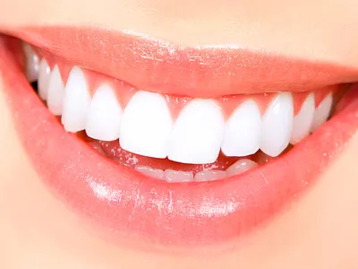Виниры на передние зубы с ортодонтической подготовкой и лечением бруксизма