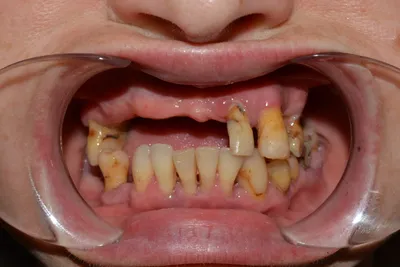 Виниры только на нижние зубы? Какие ограничения могут быть | Центр  Современной Стоматологии, Москва