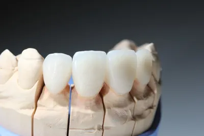 Как спиливают зубы под виниры | Блог NOVA стоматологии Драганчука