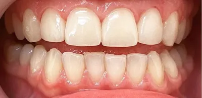 Виниры на зубы - Сеть стоматологических клиник «ОЛЬГА»