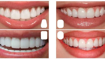 Как выбрать цвет виниров, цвета зубов по шкале вита и блич (bleach) | Виниры  натурального цвета