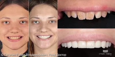 Виниры на зубы – виды и стоимость в Москве | Клиника \"МАЙ\"