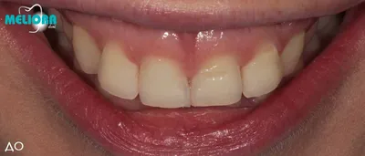 👨 Виниры на все зубы стоимость, сколько стоит протезирование |  Стоматологическая клиника Дантист