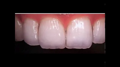 Вестибулярная часть зубов.. Металлокерамика 6 единиц...цвет А1  #стоматология#металлокерамика#фронтальная6#зубы#одесса#циркон#виниры #любыевидыпротезирования#бре…