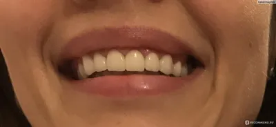 Дентиатр — ваша стоматология » Виниры и восстановление зубов