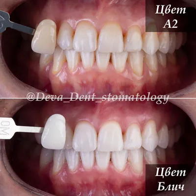 Установка виниров и коронок женщинам после 50 лет. Клиника Smile STD в  Измайлово