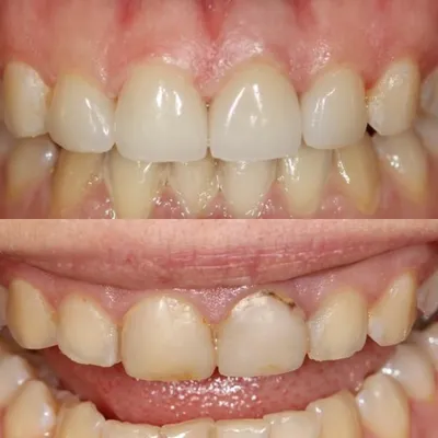 Отбеливание зубов (до/после)