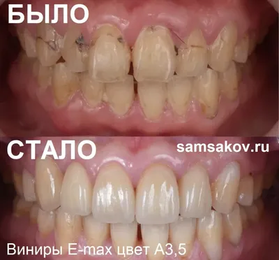 Установка виниров и коронок женщинам после 50 лет. Клиника Smile STD в  Измайлово