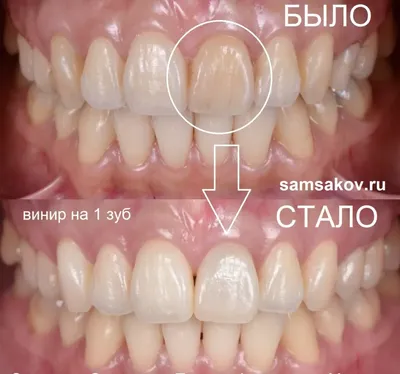 Установка виниров и коронок женщинам после 50 лет. Клиника Smile STD в  Измайлово