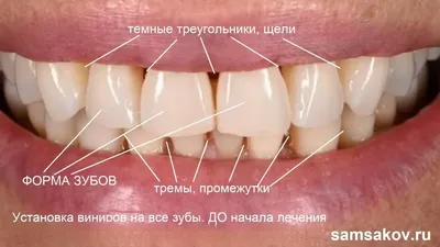 Коронки Е.max, цвет А2 #зубы... - Зуботехническая лаборатория | Facebook