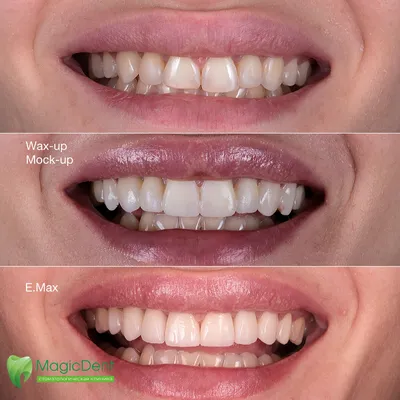 Холодное отбеливание зубов Beyond. Кейс № 2 : фото до и после |  Стоматология в СПб «Чистое Дыхание»
