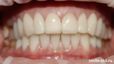 Сочетание отбеливания с последующим изготовлением винира в клинике  эстетической стоматологии - DENTALMAGAZINE.RU