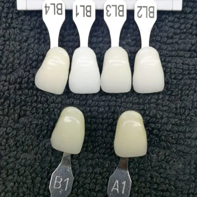 Кейсы отбеливания зубов: фото до и после в клиниках Чистое Дыхание СПб
