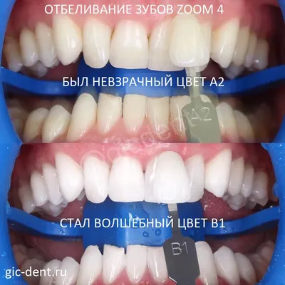 Виниры и коронки в зоне улыбки неотличимы от своих зубов! -  Стоматологическая клиника Лазурит