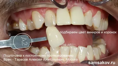 Естественный цвет зубов - особенности выбора светлого цвета