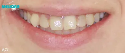 Что быстро вызывает стираемость всех зубов и дисфункцию ВНЧС? | Центр  Современной Стоматологии, Москва