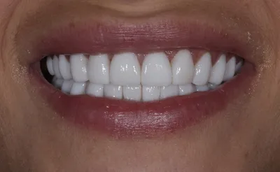 Керамические реставрации ( виниры) - Ортодонтия и Детская стоматология