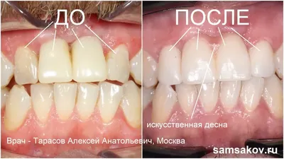 Техники протезирования винирами: минимально инвазивная и неинвазивная