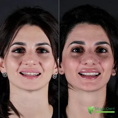 Установить виниры для зубов. Фото до и после, цена | Альянс  бьюти-ортопедов, Москва