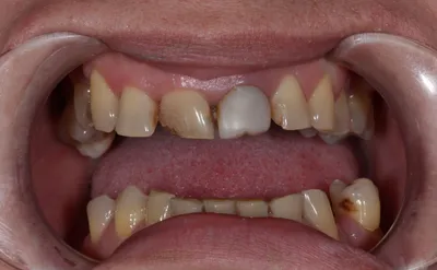 Передние зубы как ключ к красивой улыбке. Пример реставрации с фото. Альянс  бьюти-стоматологов, Москва