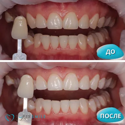 Отбеливание темных зубов без нервов перед установкой виниров - нужно или не  нужно
