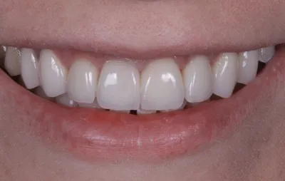 Отбеливание зубов и их реставрация лучше, чем ставить виниры. Альянс  бьюти-ортопедов, Москва