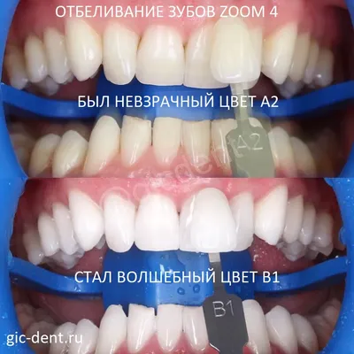 Dental clinics - Металлокерамика. Цвет В1. #металлокерамика #коронки #виниры  #керамика #кчр #09 #улыбка #красота #стоматология #стоматология09 #зубы  #отбеливаниезубов | Facebook