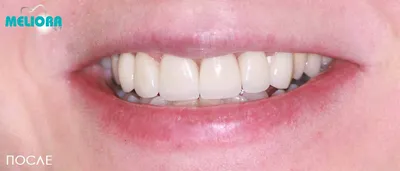 Ceramic veneers B1... - Tailor-made Dental technician area | Facebook