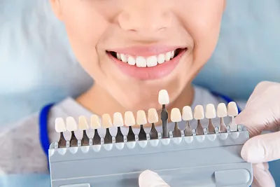 M.Vision - А ви хочете вініри?🤔🙂 Smile upgrade. New color B1. 👌Апгрейп  посмішки. Колір В1. #3shape #mvision #veneers #smile #dentist #вініри  #стоматолог #виниры #стоматология | Facebook
