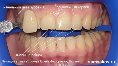 Цвета виниров: как выбрать? Блич и натуральные оттенки накладок на зубы —  ROOTT