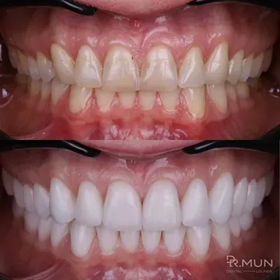Отбеливание темных зубов без нервов перед установкой виниров - нужно или не  нужно