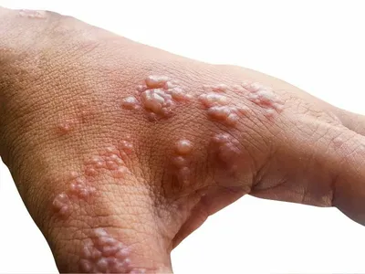 Опоясывающий лишай (опоясывающий герпес, herpes zoster): симптомы и  профилактика