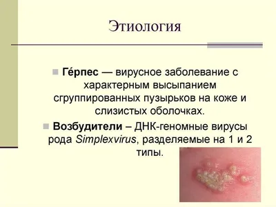 Герпес: симптомы, диагностика, профилактика. 8 видов герпесвирусной инфекции