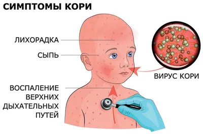 Стоит ли украинцам бояться кори? | Центр гражданского мониторинга и контроля