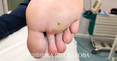 Бородавки и их симптомы – врач указала на опасность | РБК Украина