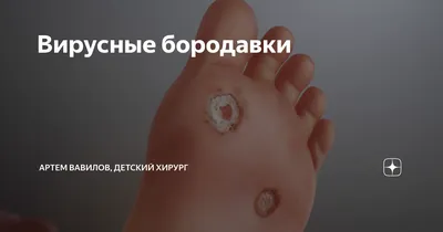 Удаление бородавок на подошве лазером – Damas Medical Center