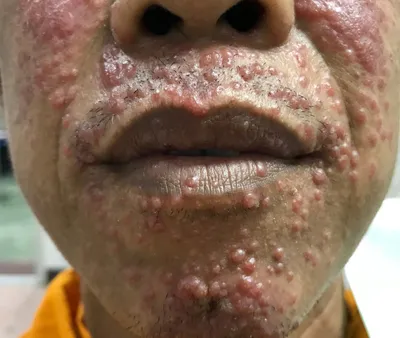 Вирусное заболевание кожи моллюск фото фото