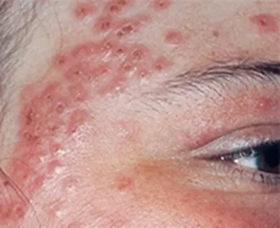 Вирусные заболевания кожи лица фото фото
