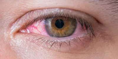 Как сохранить зрение / Воспалительные заболевания глаз. Часть 02