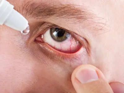 Дифференциальная диагностика и лечение синдрома красного глаза в детском  возрасте с позиций инфекциониста и офтальмолога