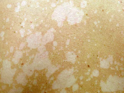 File:Tinea Versicolor (Wood's Lamp).JPG - Wikipedia