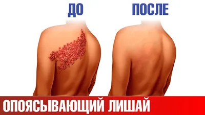 Різнокольоровий (висівкоподібний) лишай – Pityriasis versicolor – грибкова  🍄інфекція рогового ( верхнього) шару шкіри. Повязане… | Instagram