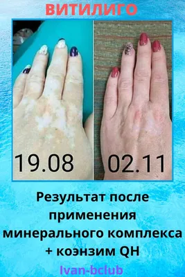 Фото витилиго до и после | Кабинет татуажа Алены Леоновой