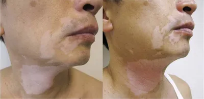 Saatov Vitiligo Clinic / Медицинская клиника Витилиго - Репигментация до  85% после 14 недель терапии 🏥 Медицинский центр «Vitiligo Clinic»  ✴️Инновационный метод лечения витилиго ✴️An innovative treatment for  vitiligo ✴️Хирургический метод лечения