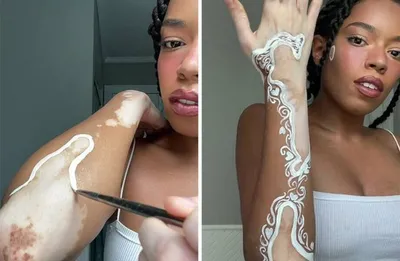 Витилиго‼️ До и после 4 процедур Каждая кожа индивидуальна, то есть  конкретно сколько процедур мы проведём, точно сказать не сможем.… |  Instagram