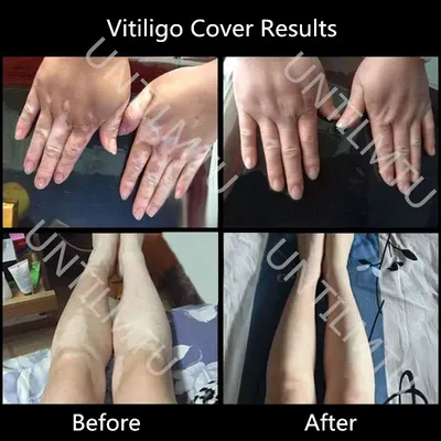 Лечение Витилиго.1 год спустя | Пикабу