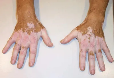 Камуфляж~Витилиго (@vitiligo_kz) | TikTok