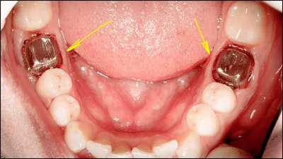 Зубные вкладки стоматологической клинике | ВАО ДЕНТ